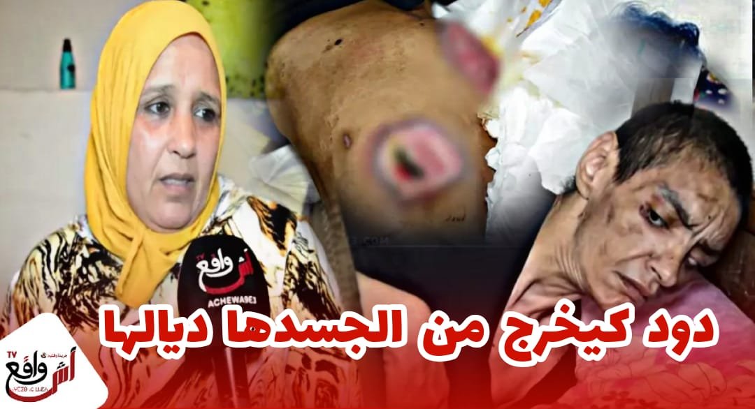 هاذ شي كيبكي.. بسبب الإهمال الطبي دود يأكل جسد سيدة بأسفي.. مبغاوش يعالجوها فسبيطار مشافوش فيها